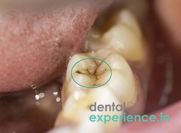 Black decayed tooth